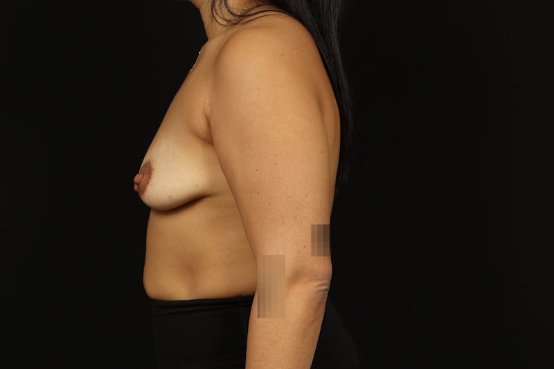 Breast Augmentation Mastopexy Before & After Gallery - Patient 181127 - Image 5