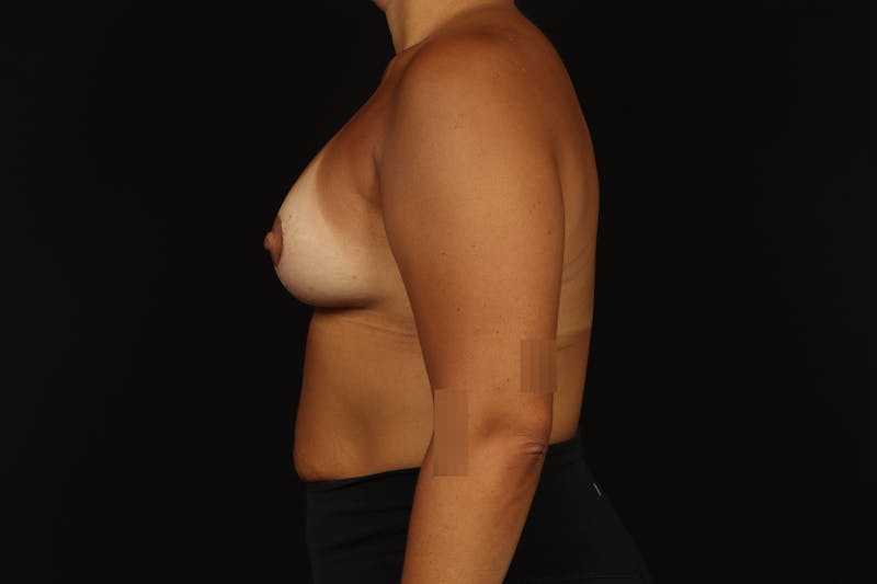 Breast Augmentation Mastopexy Before & After Gallery - Patient 181127 - Image 6