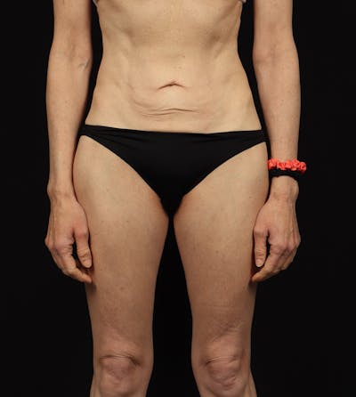 Abdominoplasty Before & After Gallery - Patient 165419 - Image 1