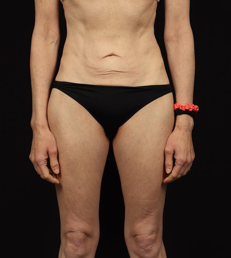 Abdominoplasty Before & After Gallery - Patient 165419 - Image 1