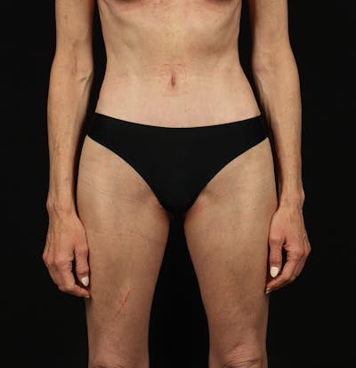Abdominoplasty Before & After Gallery - Patient 165419 - Image 2