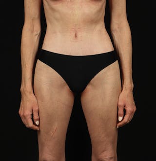 Abdominoplasty Before & After Gallery - Patient 165419 - Image 2