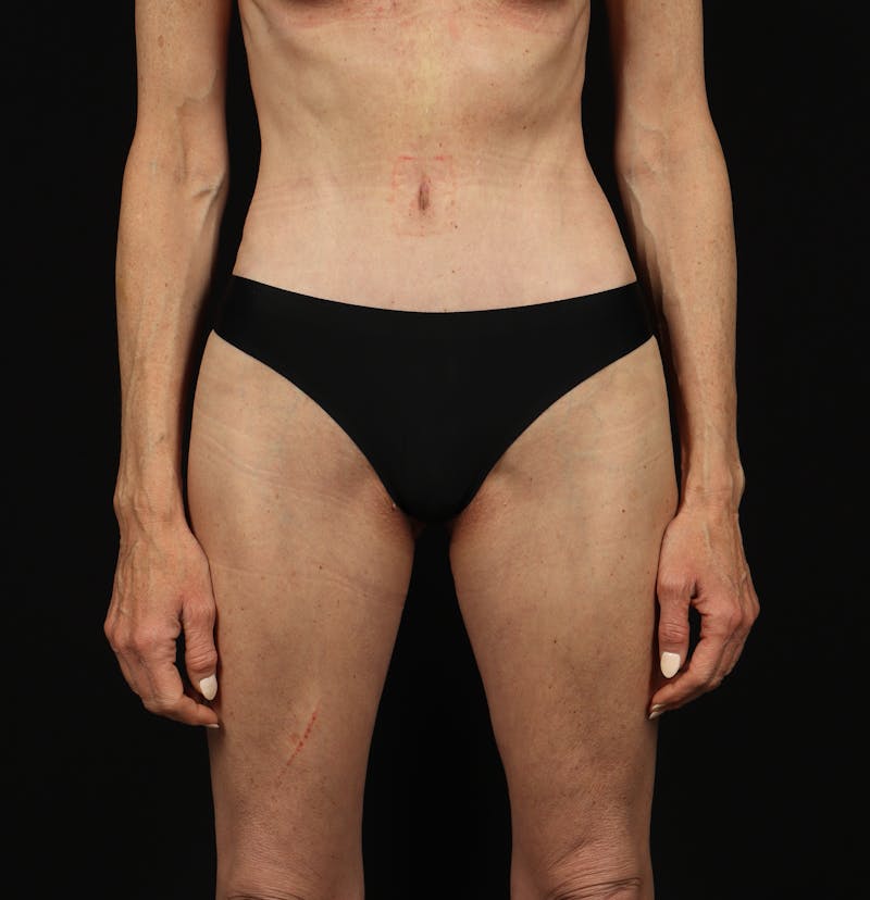 Abdominoplasty Before & After Gallery - Patient 165419 - Image 2