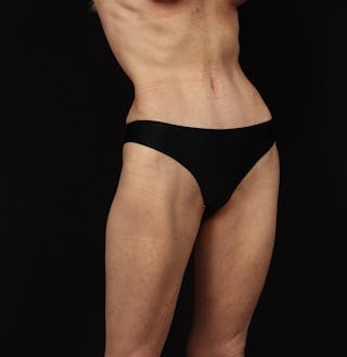Abdominoplasty Before & After Gallery - Patient 165419 - Image 8