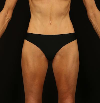 Abdominoplasty Before & After Gallery - Patient 165419 - Image 2