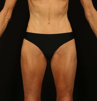Abdominoplasty Before & After Gallery - Patient 165419 - Image 2