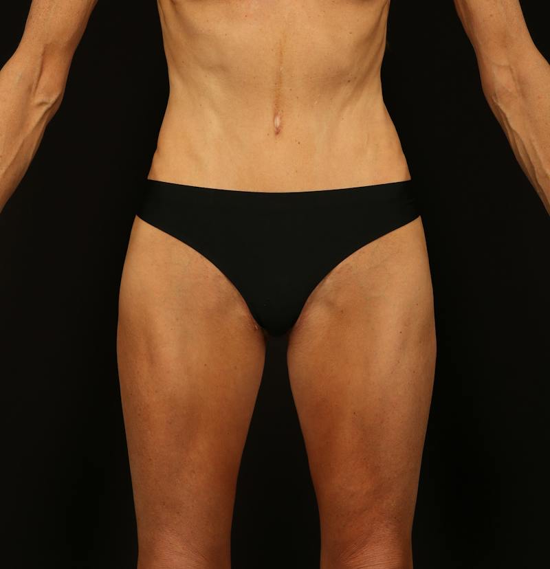 Abdominoplasty Before & After Gallery - Patient 165419 - Image 2