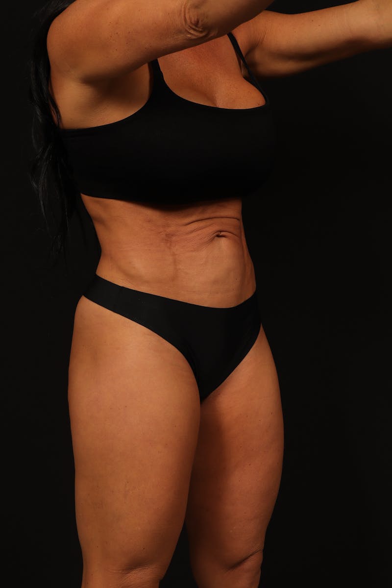 Abdominoplasty Before & After Gallery - Patient 344105 - Image 7