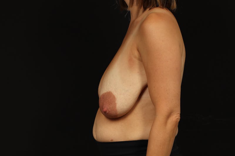 Breast Reduction Before & After Gallery - Patient 308360 - Image 5