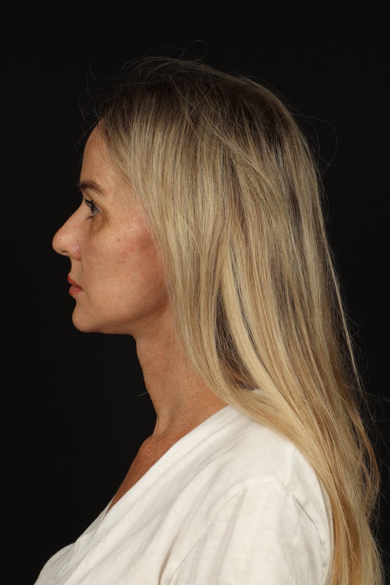 Facelift Before & After Gallery - Patient 337052 - Image 6