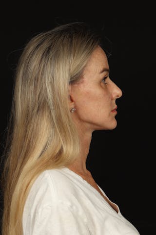 Facelift Before & After Gallery - Patient 337052 - Image 10