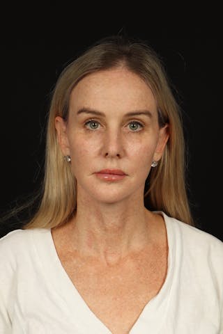 Facelift Before & After Gallery - Patient 337052 - Image 2