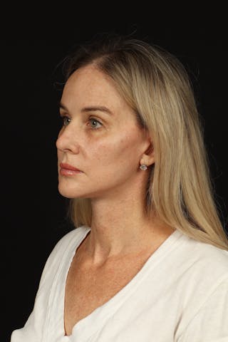 Facelift Before & After Gallery - Patient 337052 - Image 4