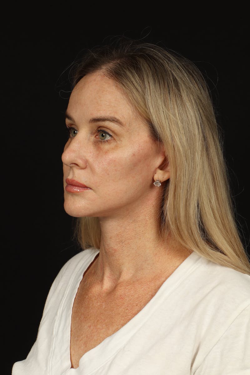 Facelift Before & After Gallery - Patient 337052 - Image 4