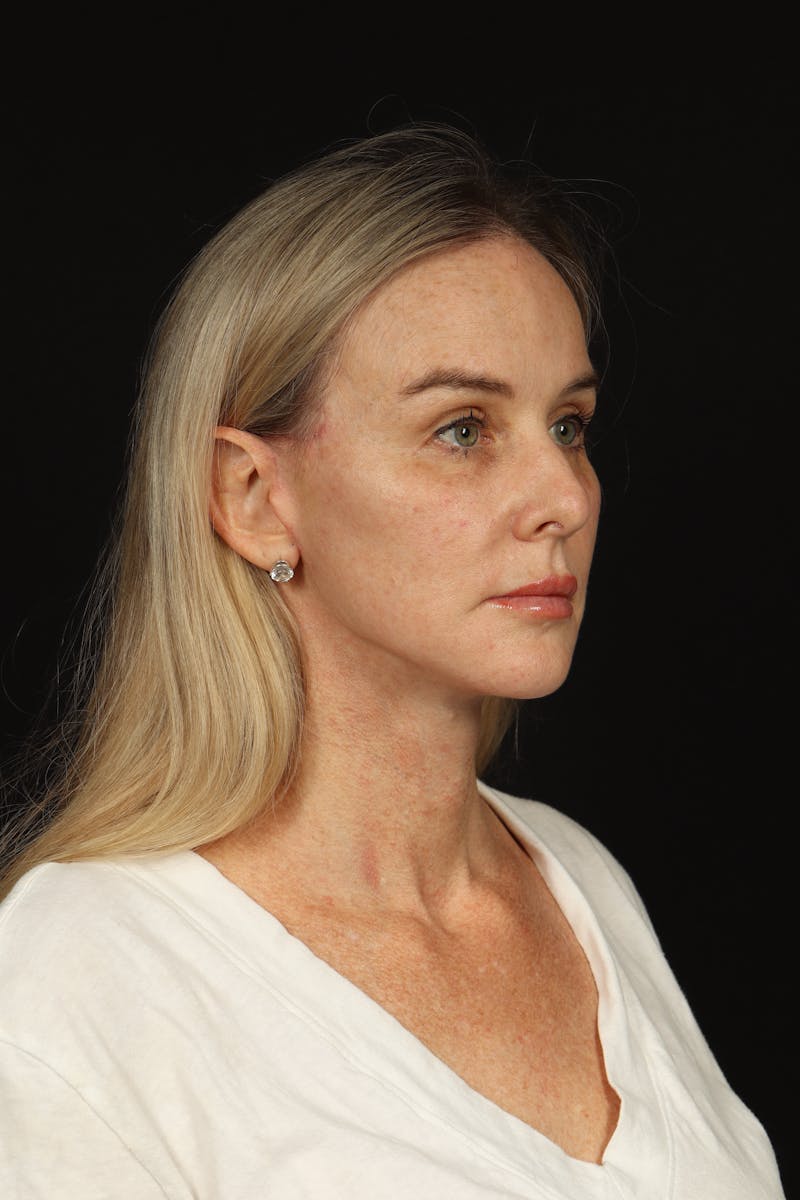 Facelift Before & After Gallery - Patient 337052 - Image 8
