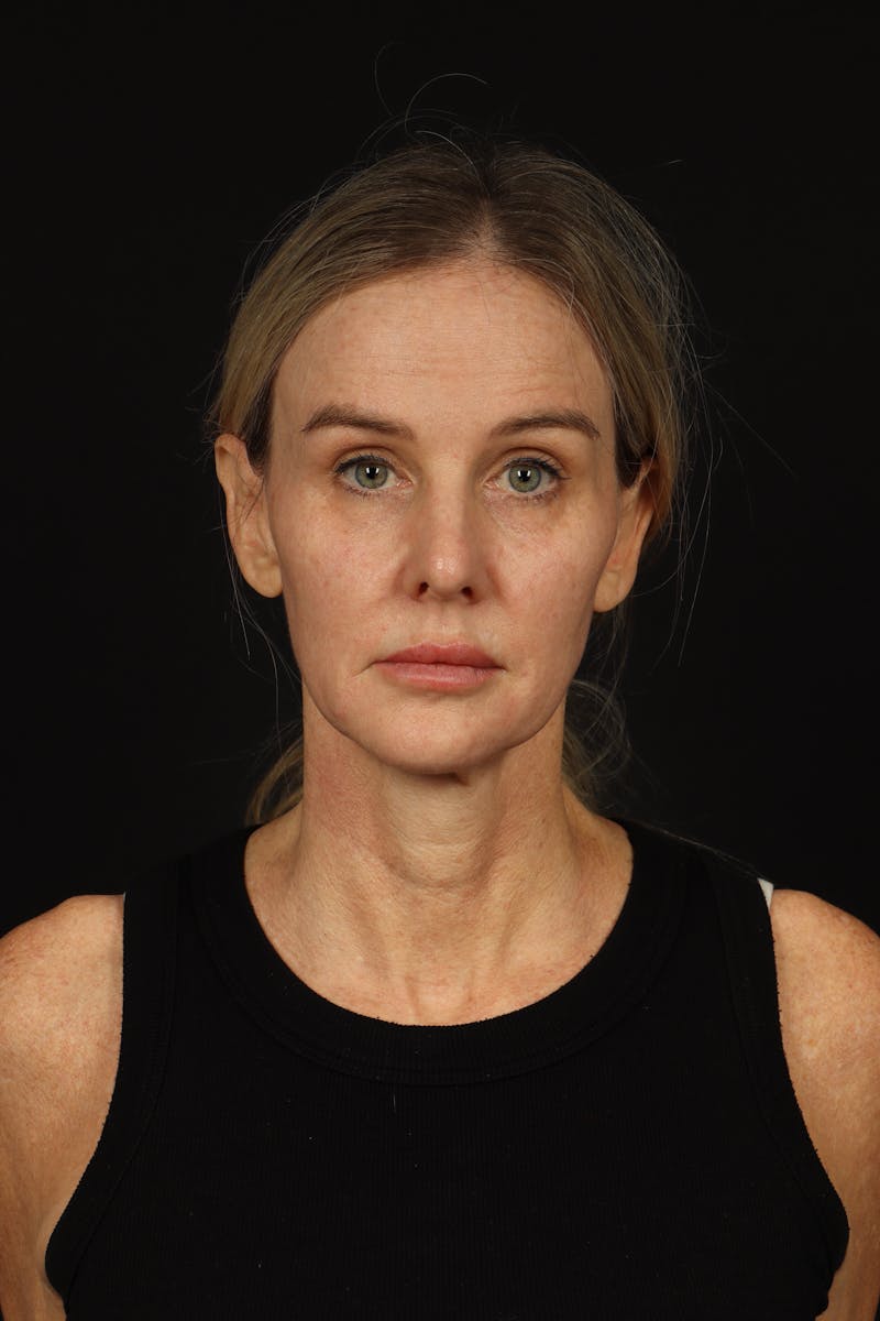 Facelift Before & After Gallery - Patient 337052 - Image 1