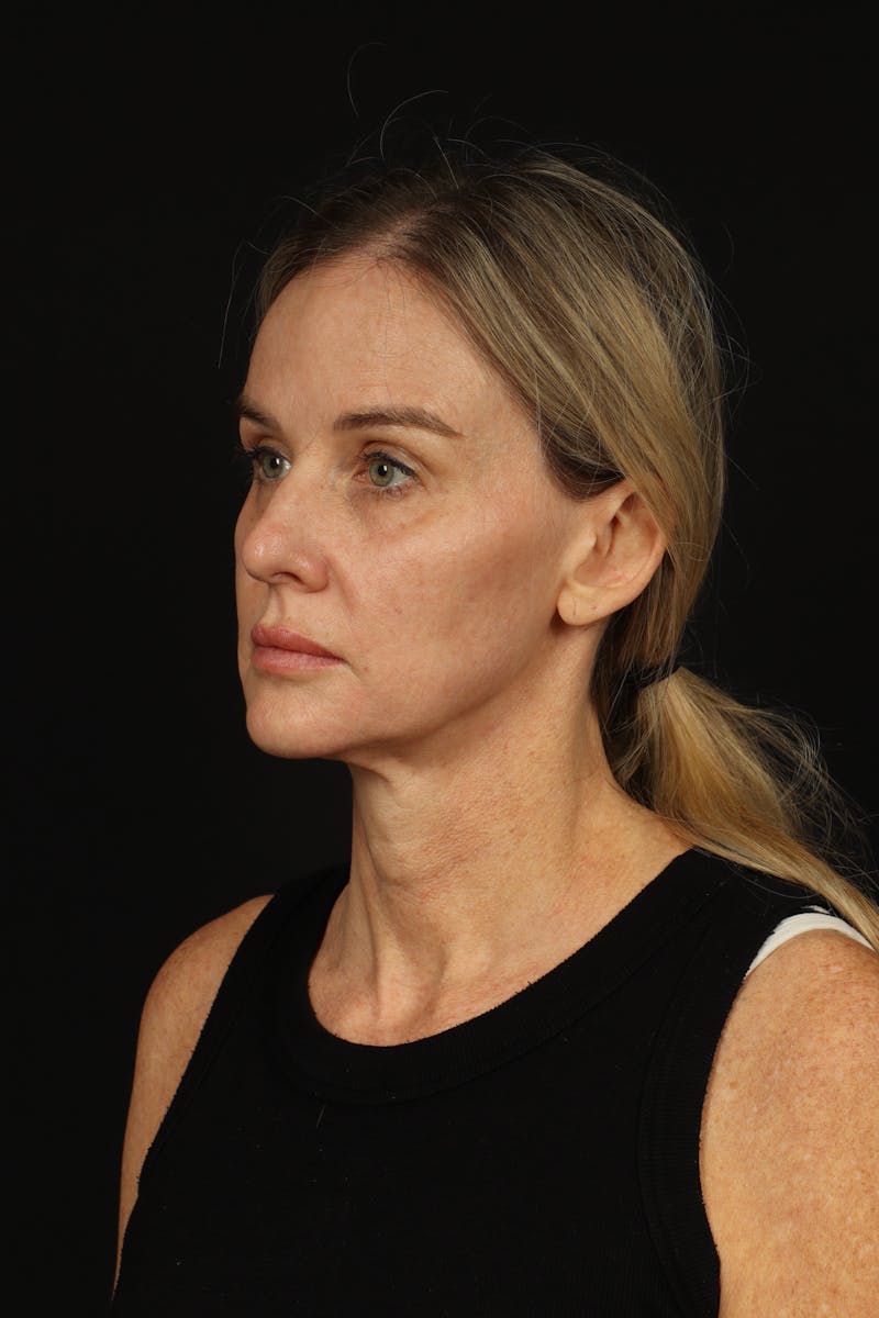 Facelift Before & After Gallery - Patient 337052 - Image 3