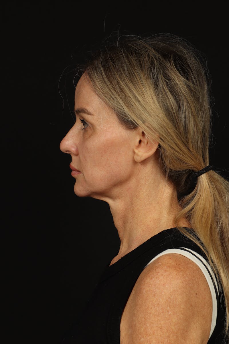 Facelift Before & After Gallery - Patient 337052 - Image 5