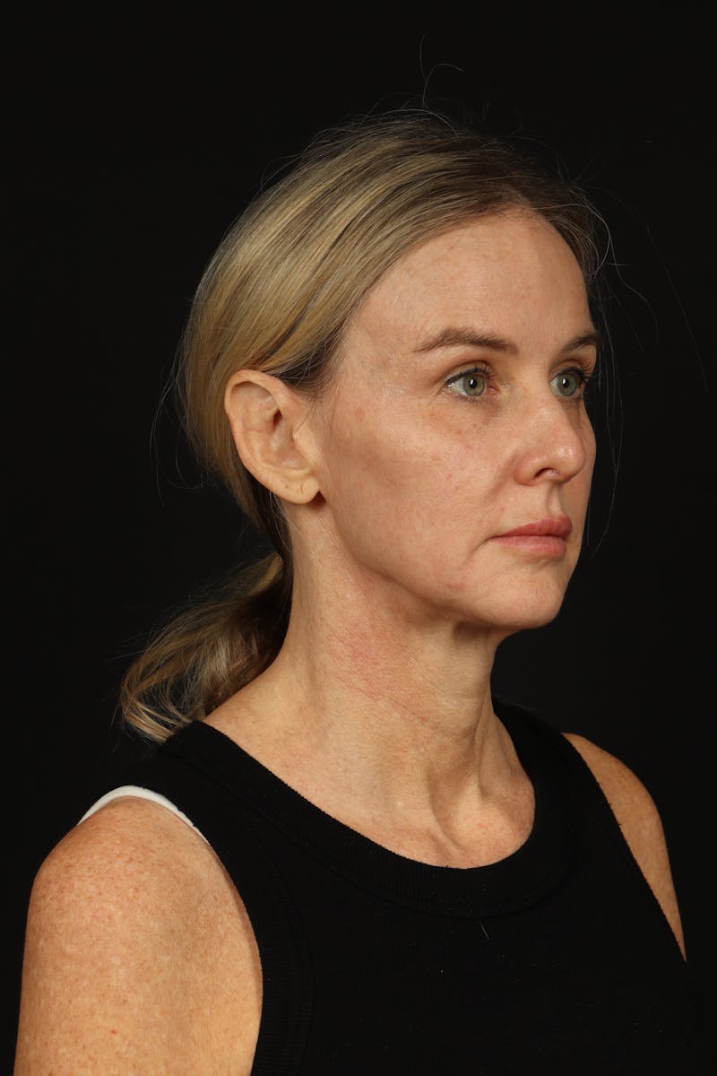 Facelift Before & After Gallery - Patient 337052 - Image 7