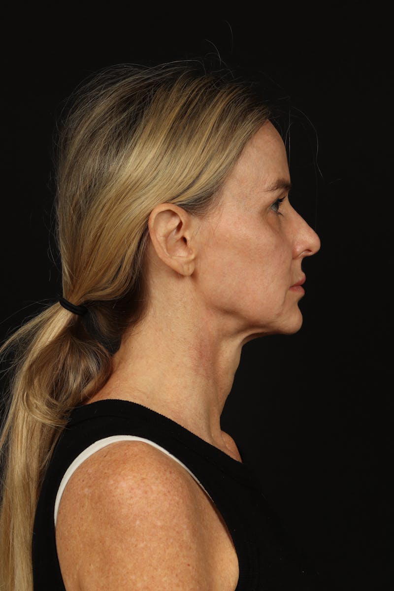 Facelift Before & After Gallery - Patient 337052 - Image 9