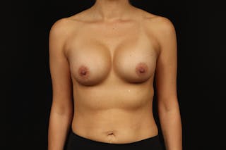 Breast Augmentation Silicone Gel Before & After Gallery - Patient 854835 - Image 2