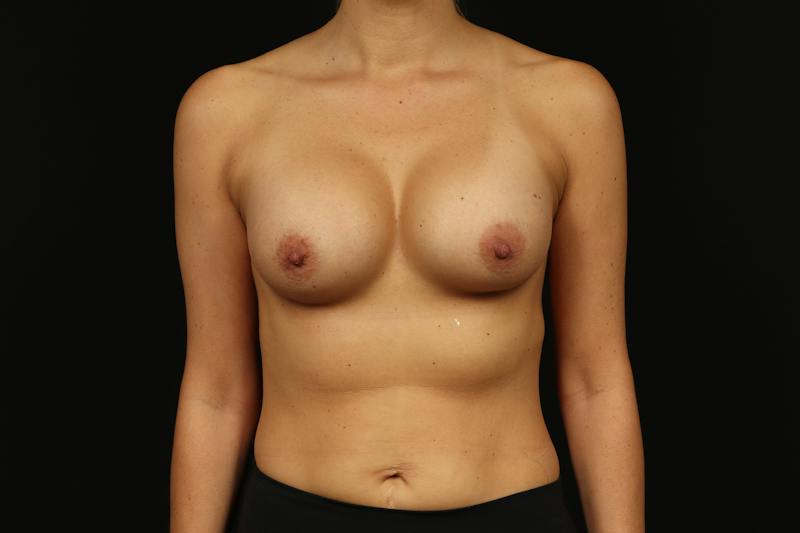 Breast Augmentation Silicone Gel Before & After Gallery - Patient 854835 - Image 2