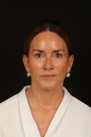 Facelift Before & After Gallery - Patient 288622 - Image 2