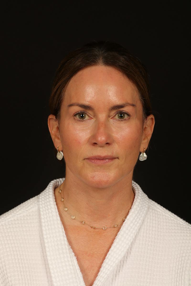 Facelift Before & After Gallery - Patient 288622 - Image 2
