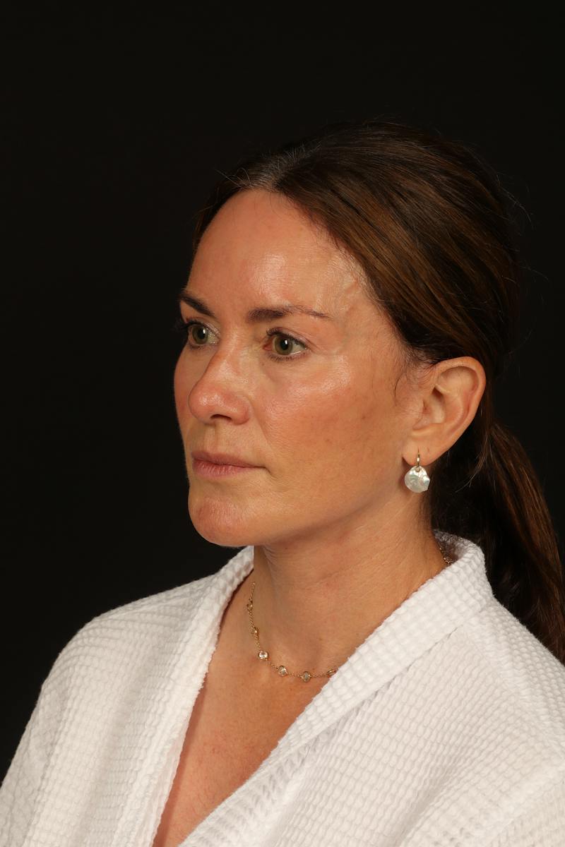 Facelift Before & After Gallery - Patient 288622 - Image 4