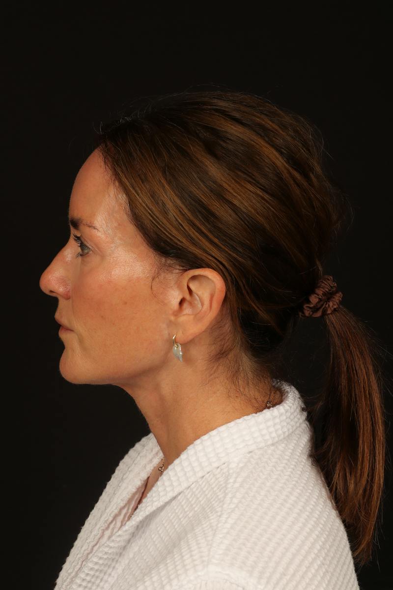 Facelift Before & After Gallery - Patient 288622 - Image 6