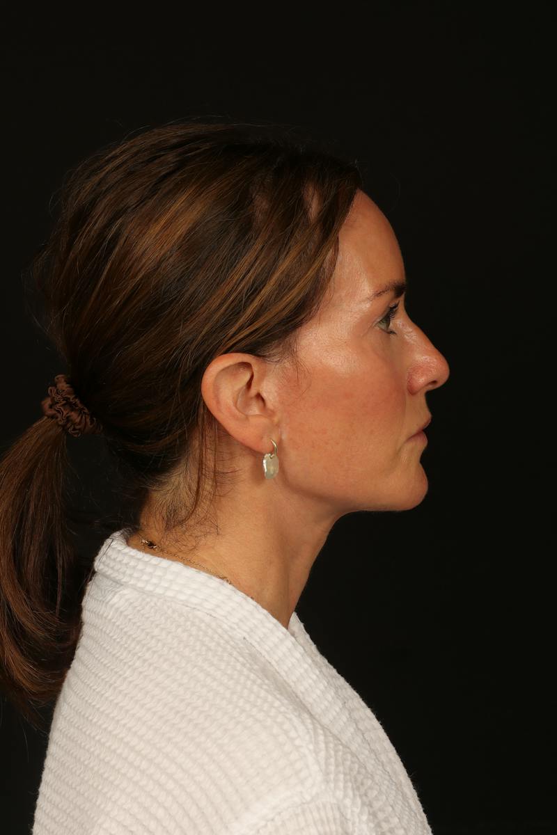 Facelift Before & After Gallery - Patient 288622 - Image 10