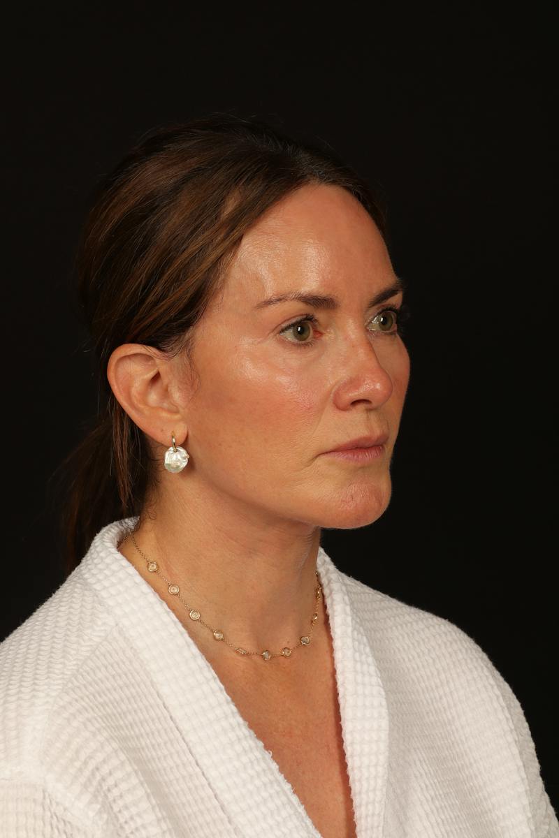 Facelift Before & After Gallery - Patient 288622 - Image 8