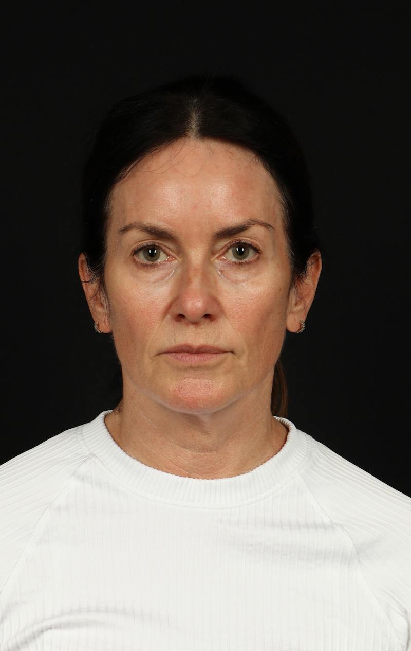 Facelift Before & After Gallery - Patient 288622 - Image 1