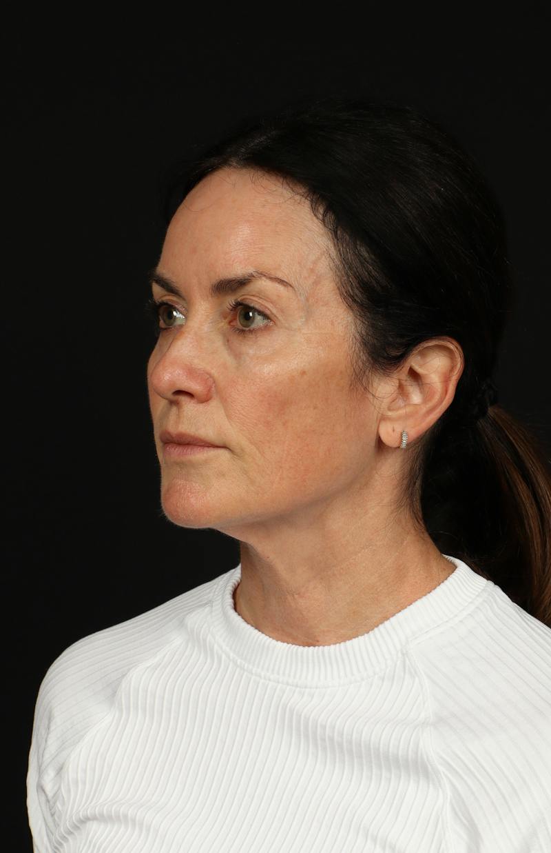 Facelift Before & After Gallery - Patient 288622 - Image 3