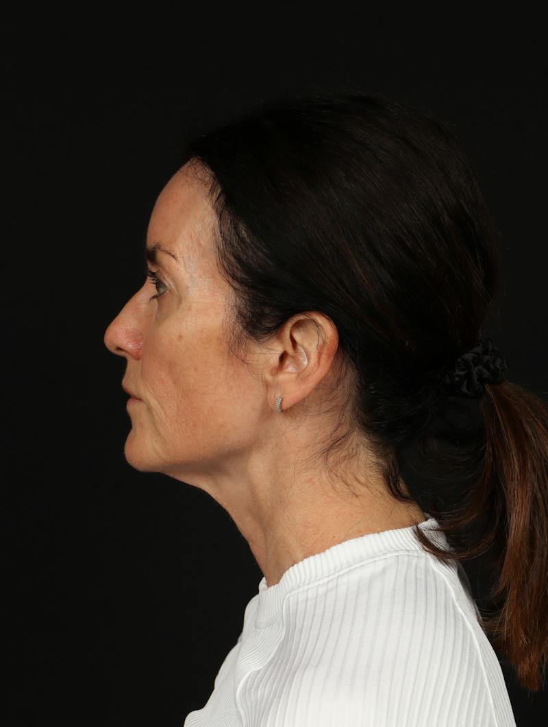 Facelift Before & After Gallery - Patient 288622 - Image 5