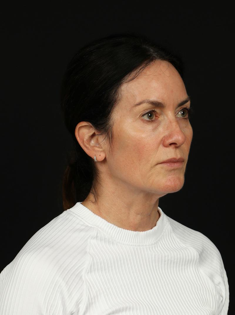 Facelift Before & After Gallery - Patient 288622 - Image 7