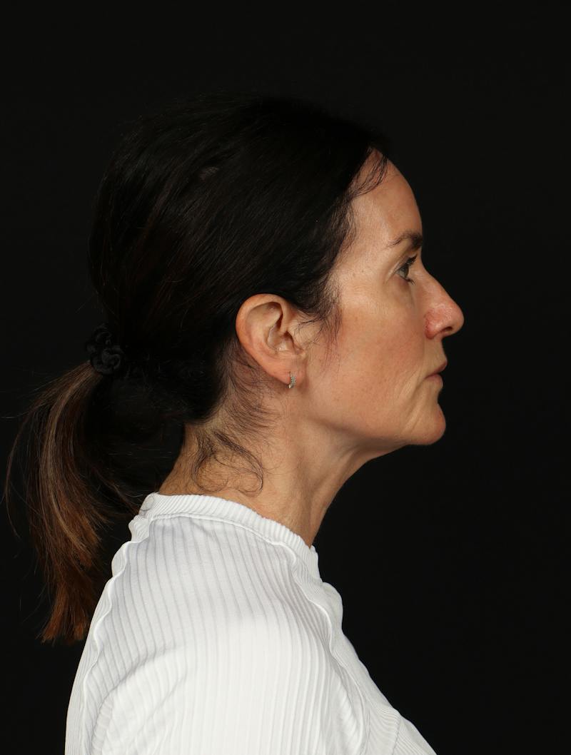 Facelift Before & After Gallery - Patient 288622 - Image 9