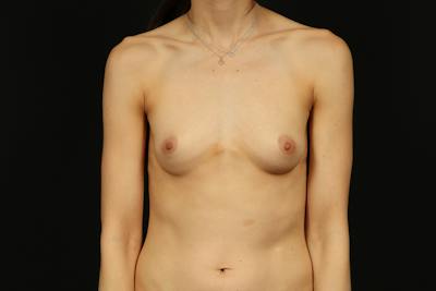 Breast Augmentation Silicone Gel Before & After Gallery - Patient 884209 - Image 1
