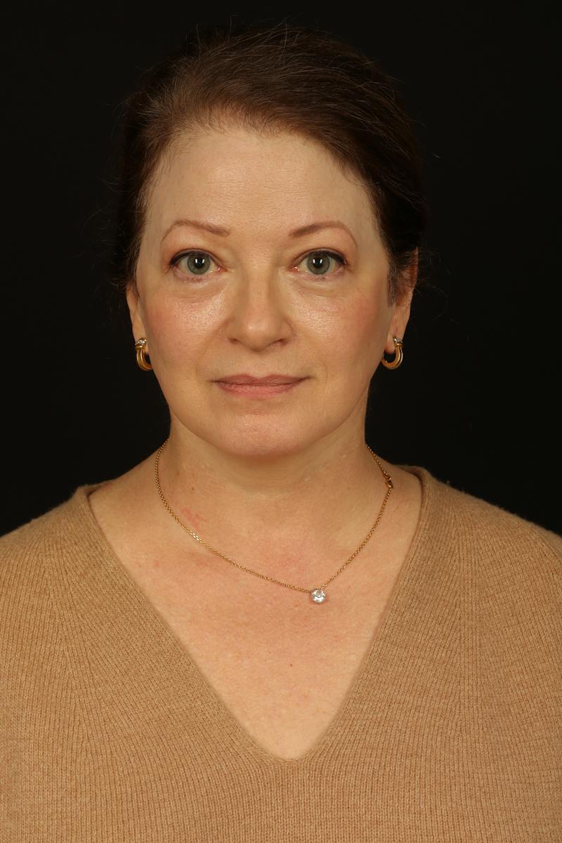 Facelift Before & After Gallery - Patient 432829 - Image 2