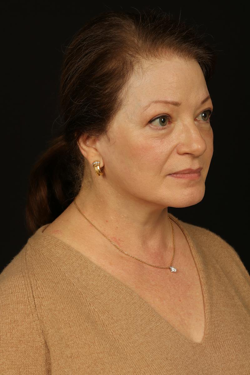 Facelift Before & After Gallery - Patient 432829 - Image 8
