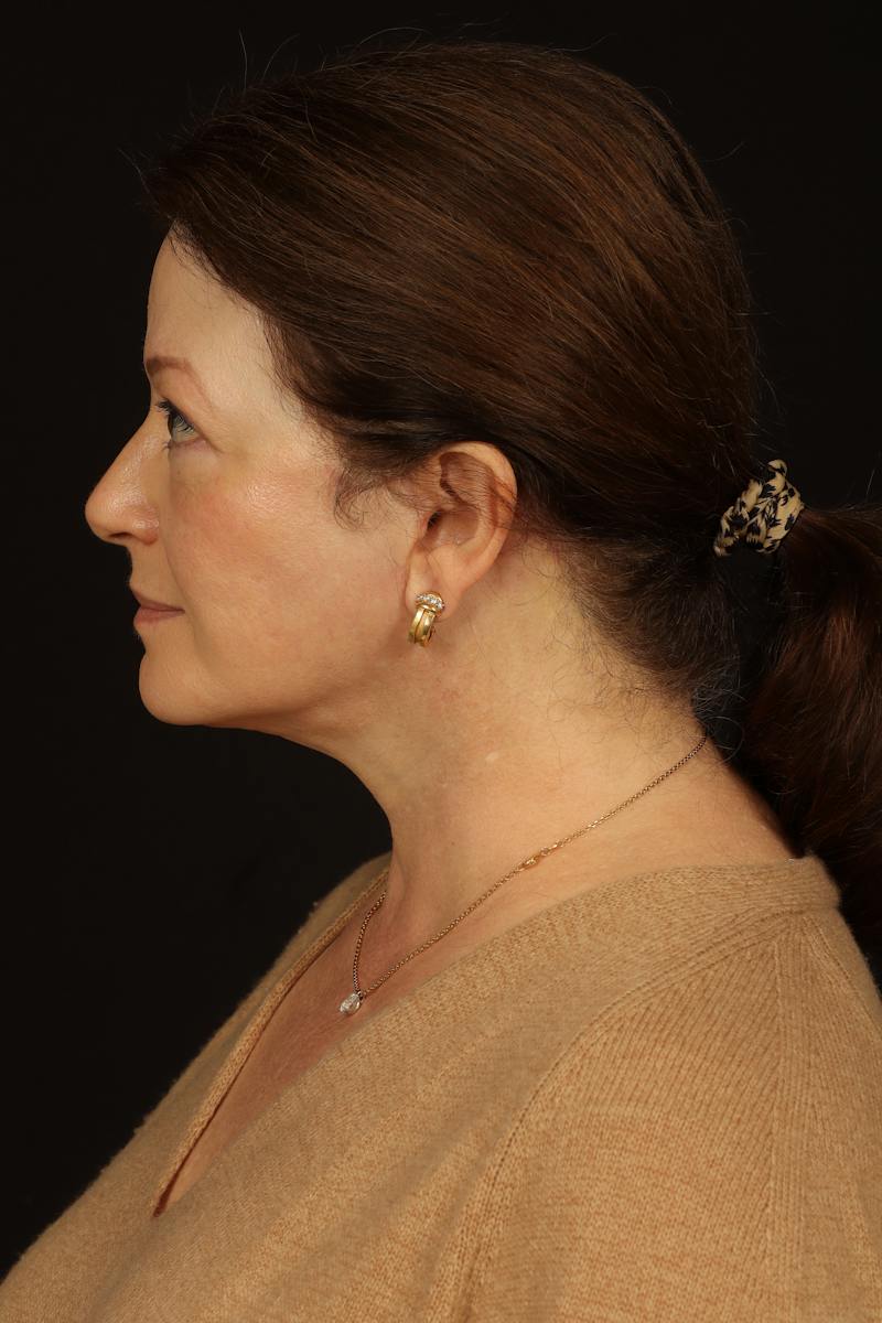 Facelift Before & After Gallery - Patient 432829 - Image 6