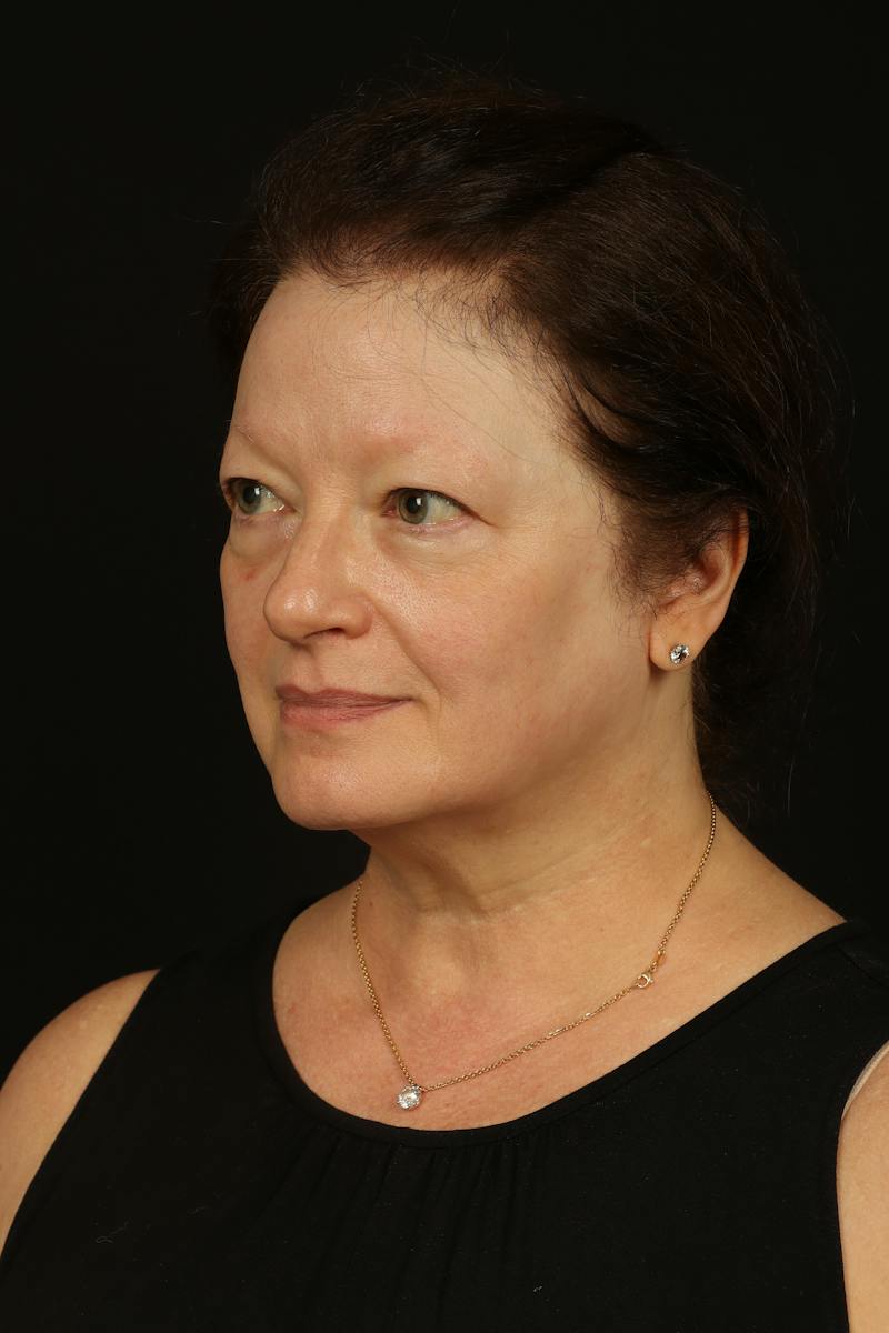 Facelift Before & After Gallery - Patient 432829 - Image 3
