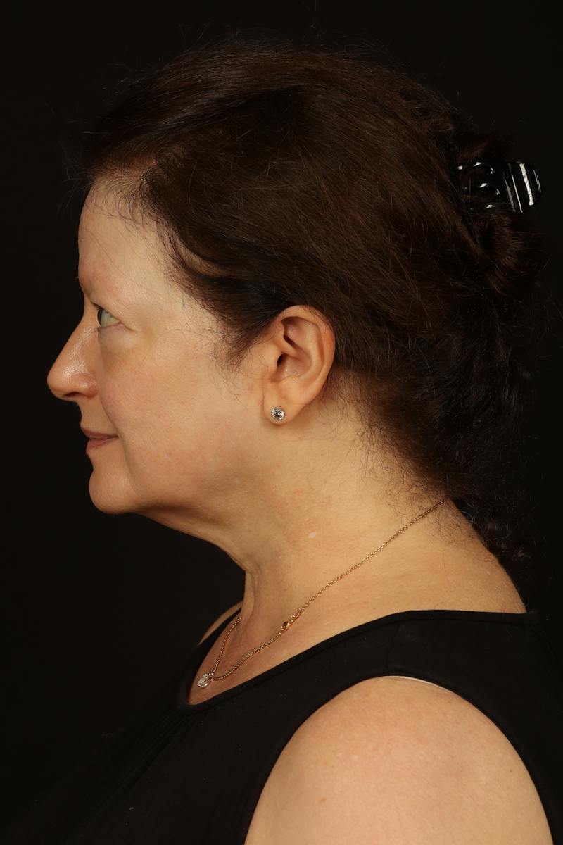 Facelift Before & After Gallery - Patient 432829 - Image 5