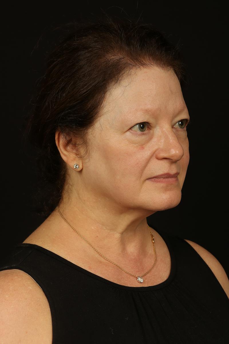 Facelift Before & After Gallery - Patient 432829 - Image 7