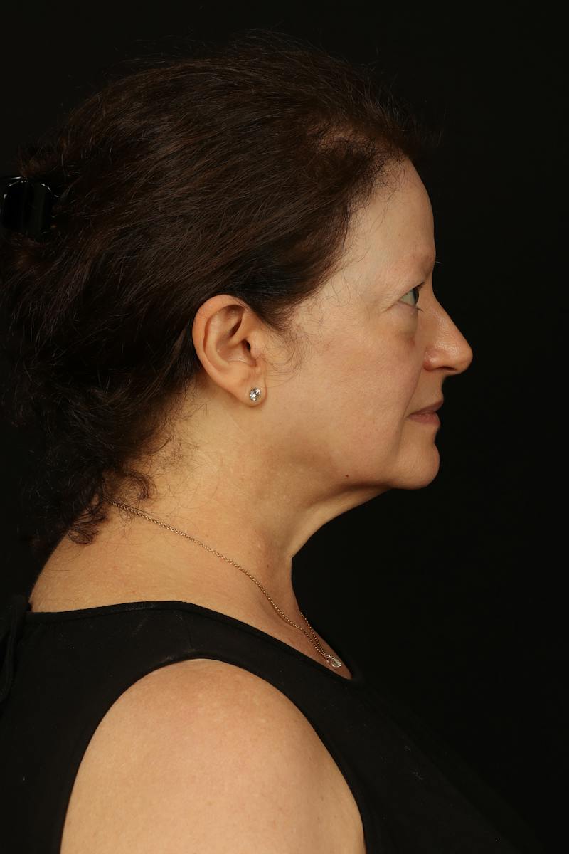 Facelift Before & After Gallery - Patient 432829 - Image 9