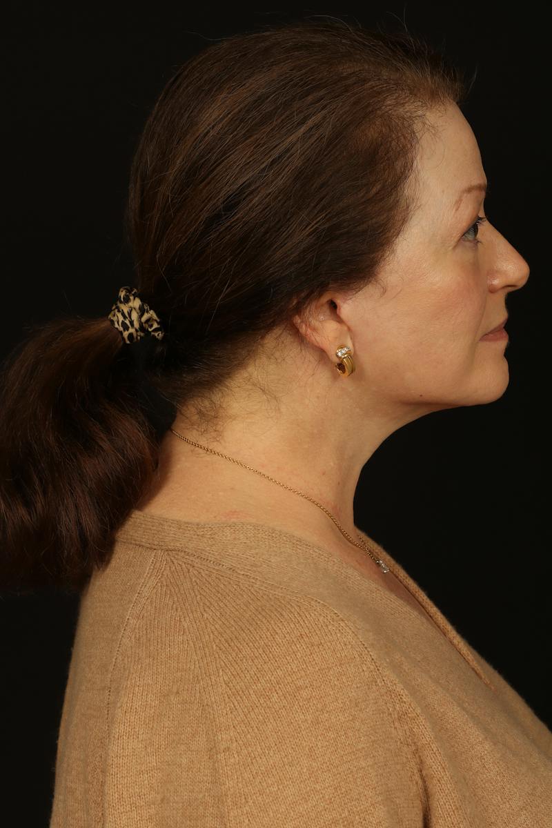 Facelift Before & After Gallery - Patient 432829 - Image 10