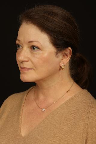 Facelift Before & After Gallery - Patient 432829 - Image 4