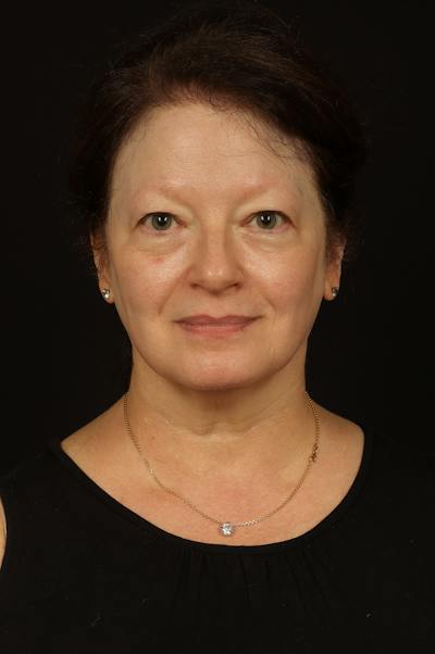 Facelift Before & After Gallery - Patient 432829 - Image 1