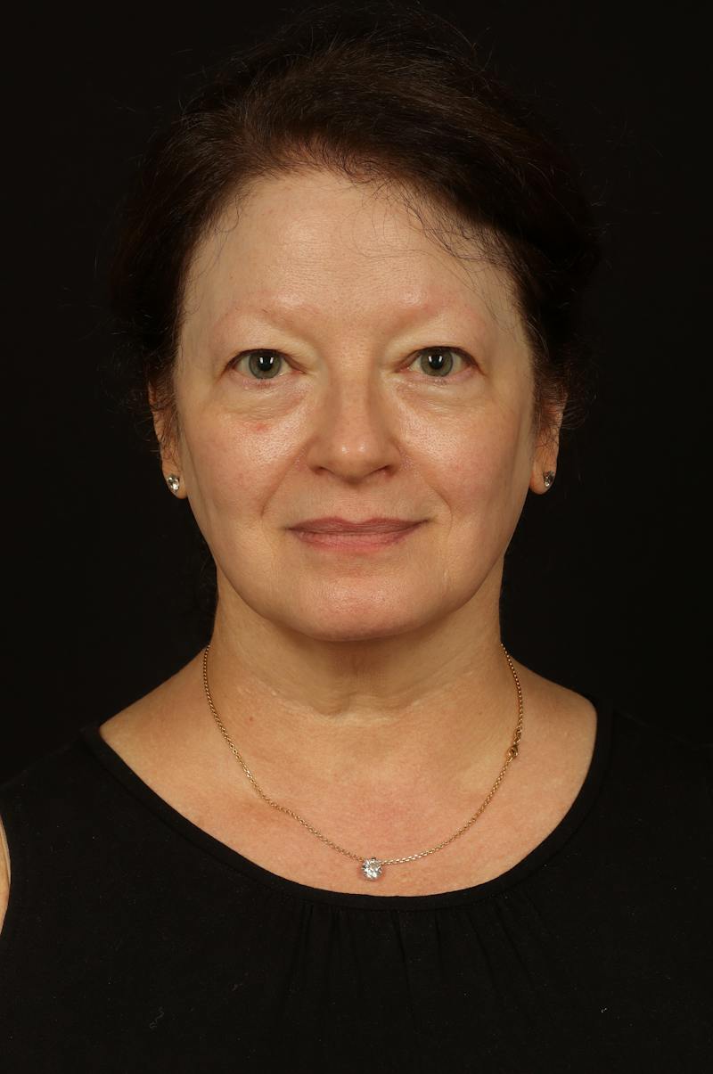 Facelift Before & After Gallery - Patient 432829 - Image 1