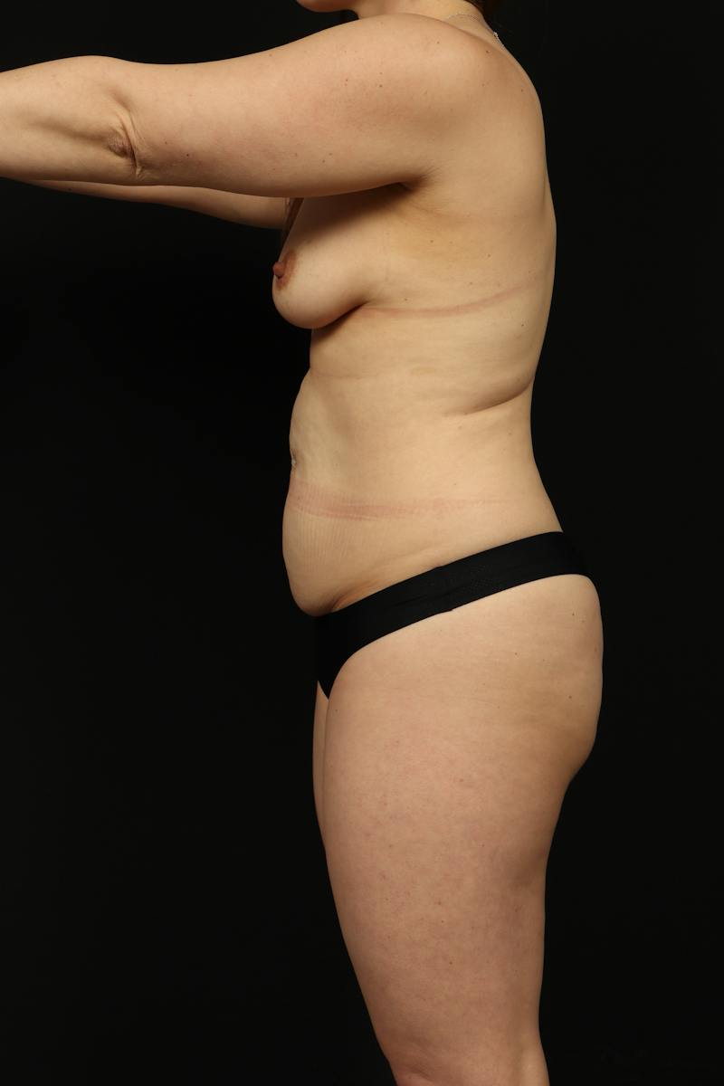 Breast Augmentation Mastopexy Before & After Gallery - Patient 917950 - Image 5